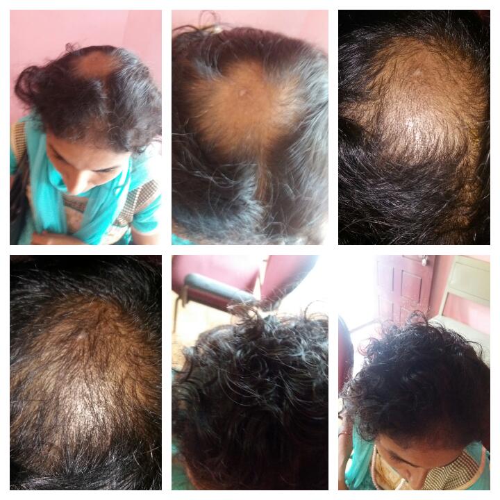 Hair Treatment at Sree Nandanam Ayurveda Hospital, Attingal, Thiruvananthapuram