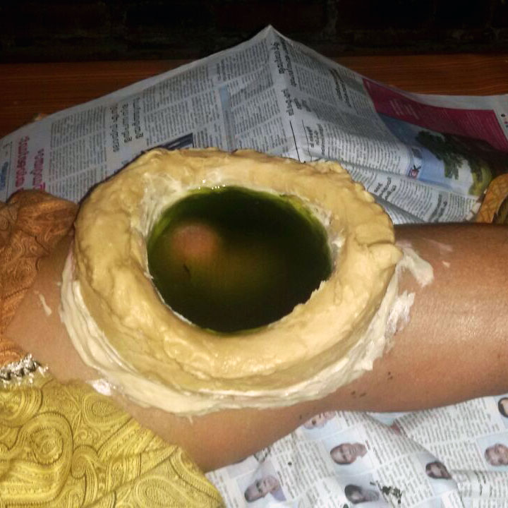 Janu Vasti therapy at Sree Nandanam Ayurveda Hospital, Attingal, Thiruvananthapuram